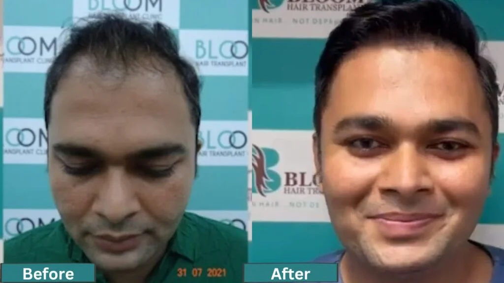 Before and After 2